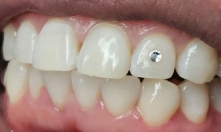Dents blanchies, l'une ornée d'un bijou dentaire Swarovski