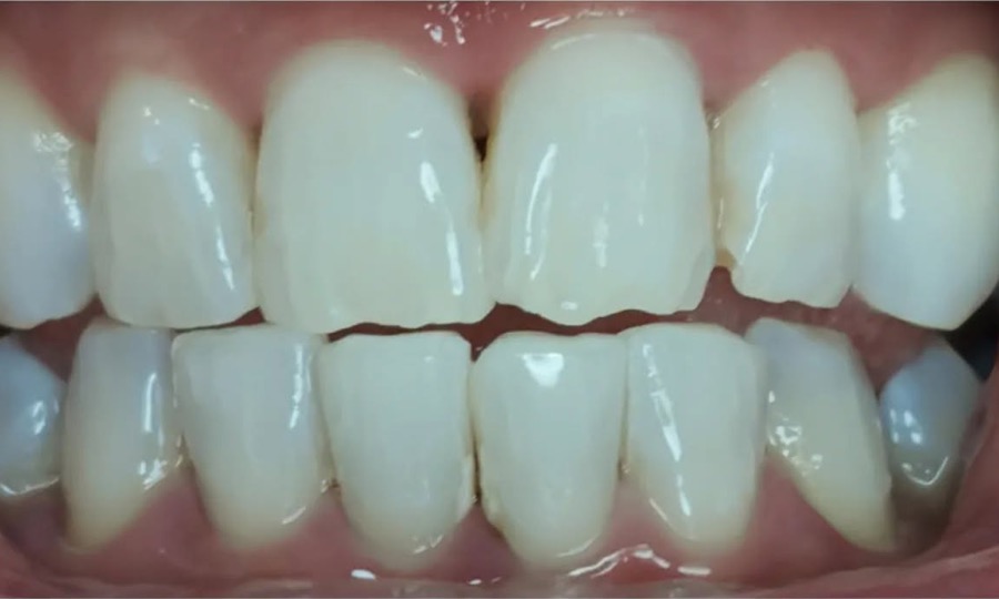 Dents après un blanchiment dentaire américain en deux séances