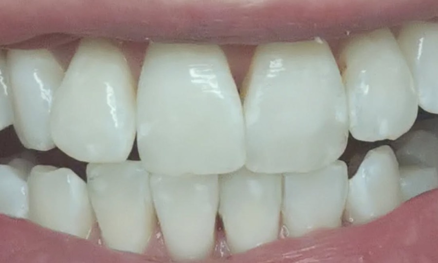 Dents de face après un blanchiment dentaire américain en deux séances
